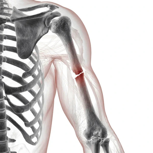 Massage: Fractures and Broken Bones - Understanding the Risks