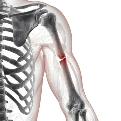 Massage: Fractures and Broken Bones - Understanding the Risks